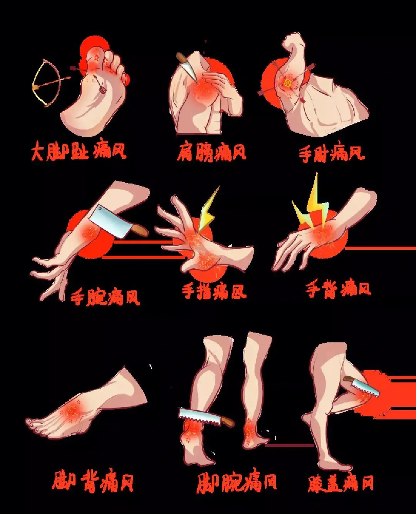 重慶痛風(fēng)急診看(kàn)什(shén)麽科(kē)